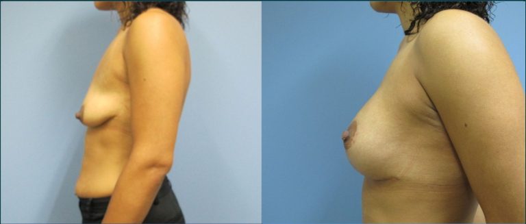 Breast lift with implants (augmentation mastopexy) before and after, female patient, case BLA-L02, Dr Rohit Kumar, Sydney
