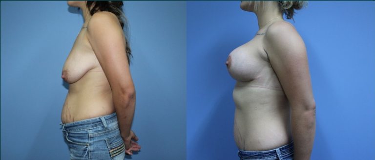 Breast lift with implants (augmentation mastopexy) before and after, female patient, case BLA-L03, Dr Rohit Kumar, Sydney