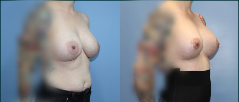 Breast lift with implants (augmentation mastopexy) before and after, 45° right view, female patient, case BLA-L04, Dr Rohit Kumar, Sydney