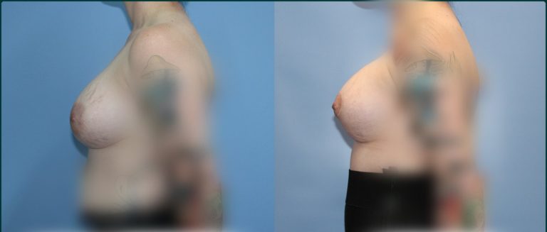 Breast lift with implants (augmentation mastopexy) before and after, 90° left view, female patient, case BLA-L04, Dr Rohit Kumar, Sydney