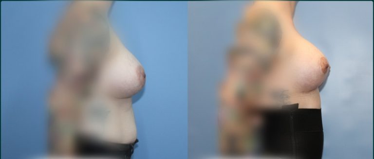 Breast lift with implants (augmentation mastopexy) before and after, 90° right view, female patient, case BLA-L04, Dr Rohit Kumar, Sydney