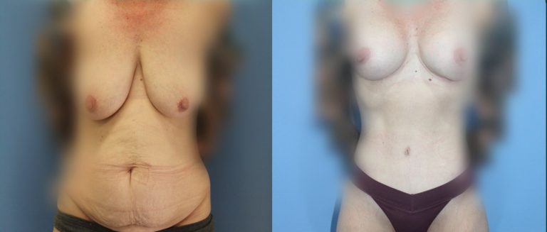 Breast lift with implants (augmentation mastopexy) before and after, front view, female patient, case BLA-L05, Dr Rohit Kumar, Sydney