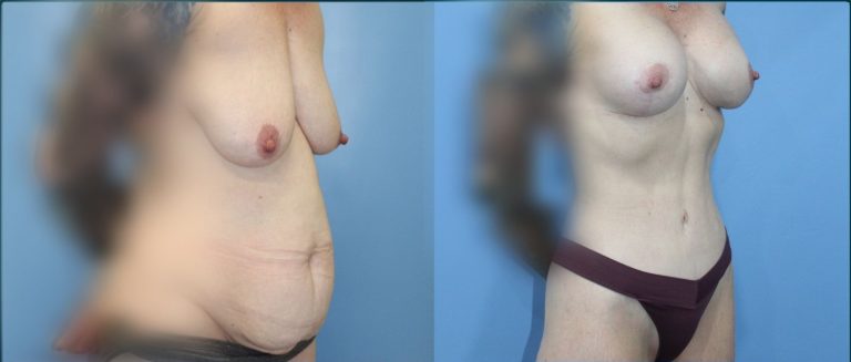 Breast lift with implants (augmentation mastopexy) before and after, female patient, case BLA-L05, Dr Rohit Kumar, Sydney