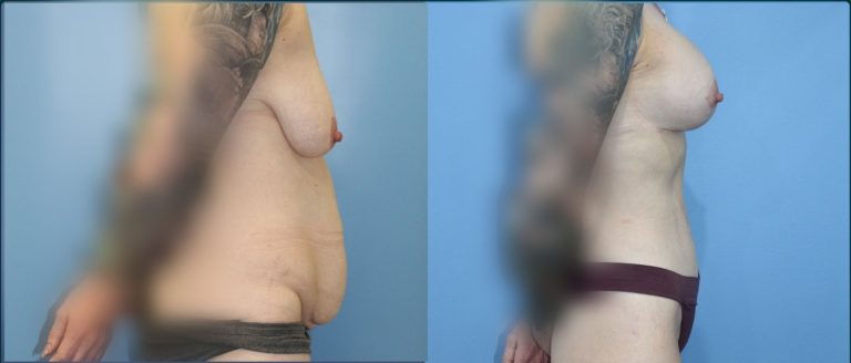 Breast lift with implants (augmentation mastopexy) before and after, female patient, case BLA-L05, Dr Rohit Kumar, Sydney