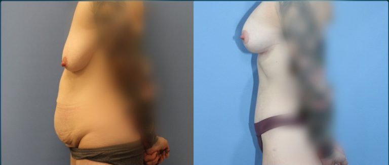 Breast lift with implants (augmentation mastopexy) before and after, female patient, case BLA-L05, Dr Rohit Kumar, Sydney