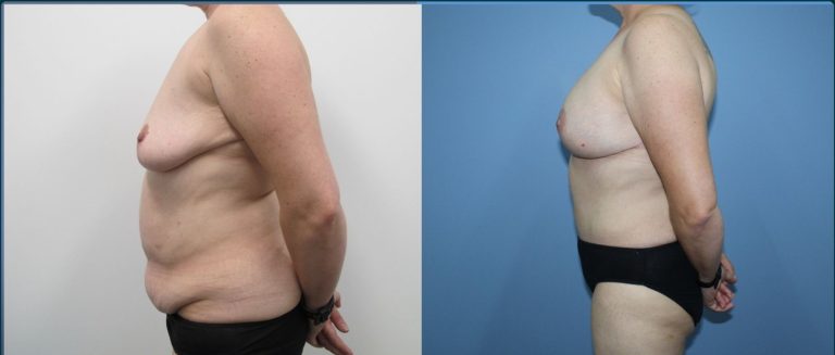 Breast lift with implants (augmentation mastopexy) before and after, 90° left view, female patient, case BLA-L06, Dr Rohit Kumar, Sydney