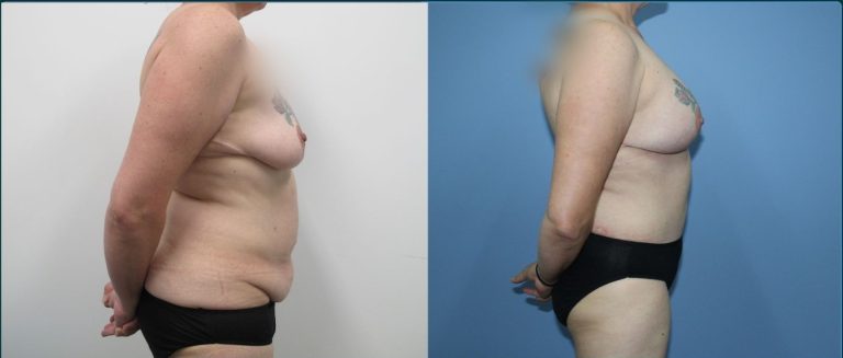 Breast lift with implants (augmentation mastopexy) before and after, 90° right view, female patient, case BLA-L06, Dr Rohit Kumar, Sydney