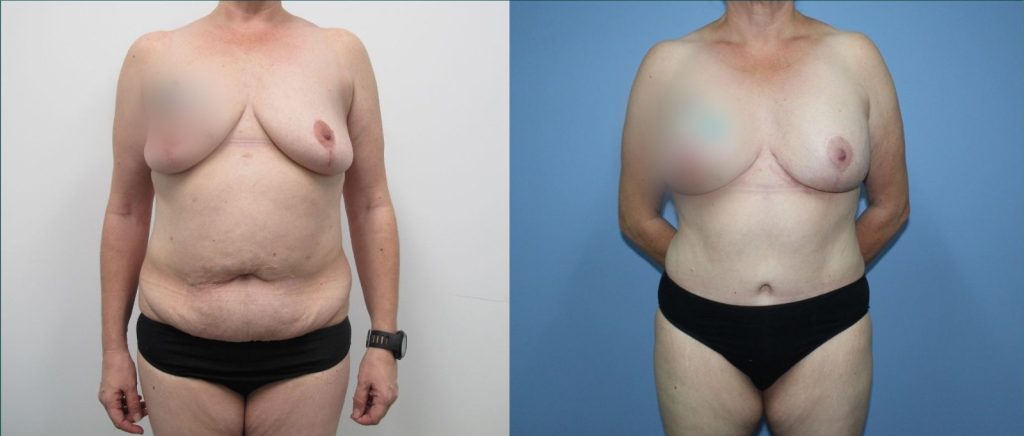 Breast lift with implants (augmentation mastopexy) before and after, front view, female patient, case BLA-L06, Dr Rohit Kumar, Sydney