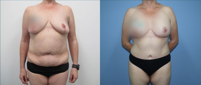 Breast lift with implants (augmentation mastopexy) before and after, front view, female patient, case BLA-L06, Dr Rohit Kumar, Sydney