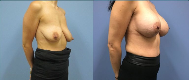 Breast lift with implants (augmentation mastopexy) before and after, 45° right view, female patient, case BLA-L07, Dr Rohit Kumar, Sydney