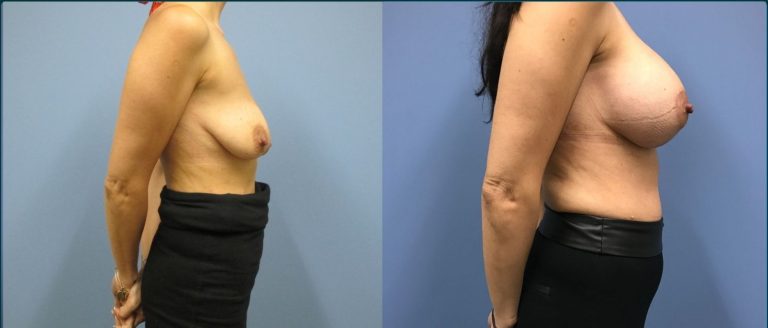 Breast lift with implants (augmentation mastopexy) before and after, 90° right view, female patient, case BLA-L07, Dr Rohit Kumar, Sydney
