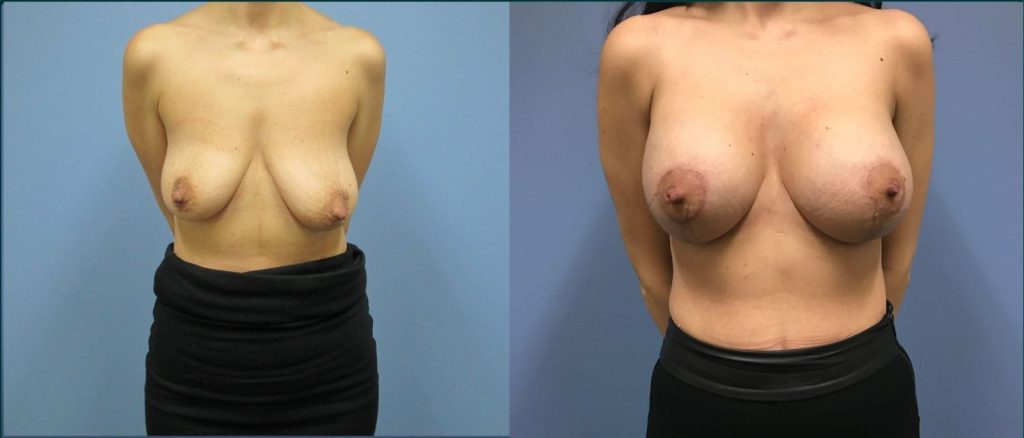 Breast lift with implants (augmentation mastopexy) before and after, front view, female patient, case BLA-L07, Dr Rohit Kumar, Sydney