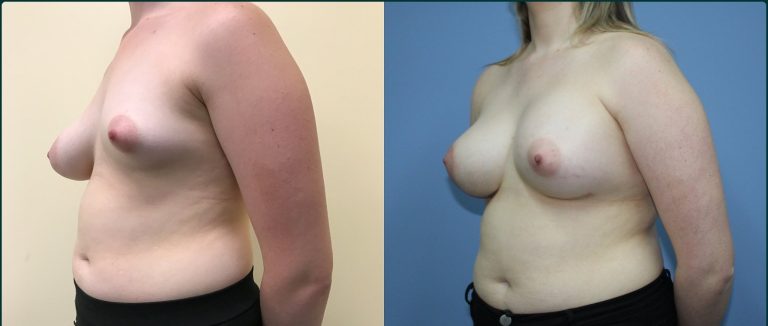 Breast lift with implants (augmentation mastopexy) before and after, 45° left view, female patient, case BLA-L08, Dr Rohit Kumar, Sydney