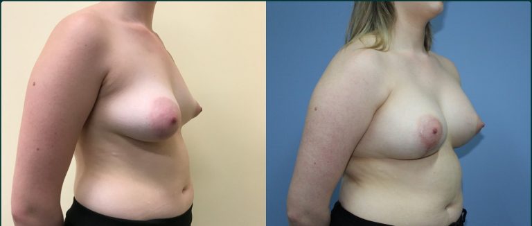 Breast lift with implants (augmentation mastopexy) before and after, 45° right view, female patient, case BLA-L08, Dr Rohit Kumar, Sydney