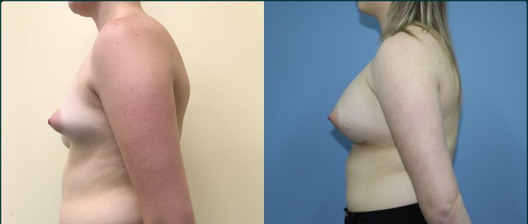 Breast lift with implants (augmentation mastopexy) before and after, 90° left view, female patient, case BLA-L08, Dr Rohit Kumar, Sydney