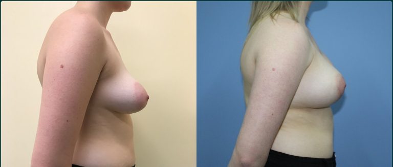 Breast lift with implants (augmentation mastopexy) before and after, 90° right view, female patient, case BLA-L08, Dr Rohit Kumar, Sydney