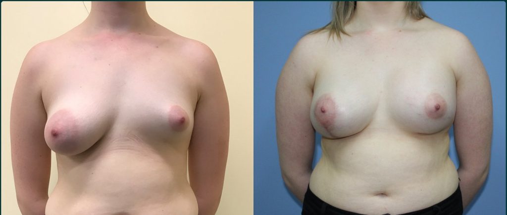 Breast lift with implants (augmentation mastopexy) before and after, front view, female patient, case BLA-L08, Dr Rohit Kumar, Sydney