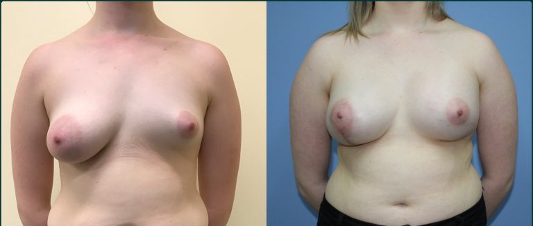 Breast lift with implants (augmentation mastopexy) before and after, front view, female patient, case BLA-L08, Dr Rohit Kumar, Sydney