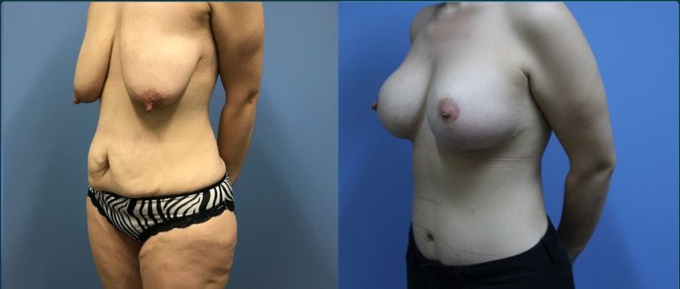 Breast lift with implants (augmentation mastopexy) before and after, 45° left view, female patient, case BLA-L09, Dr Rohit Kumar, Sydney
