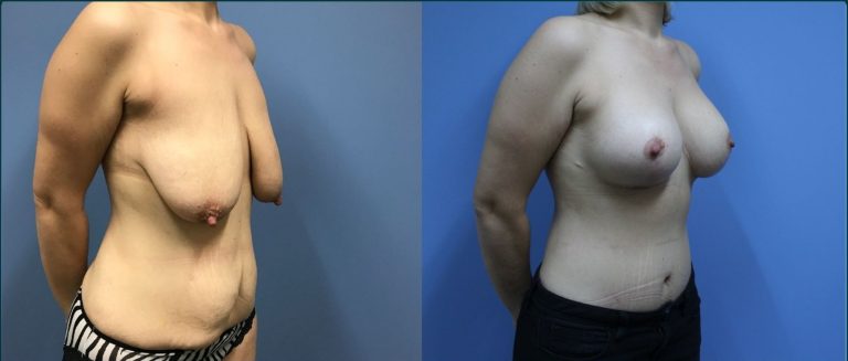 Breast lift with implants (augmentation mastopexy) before and after, 45° right view, female patient, case BLA-L09, Dr Rohit Kumar, Sydney