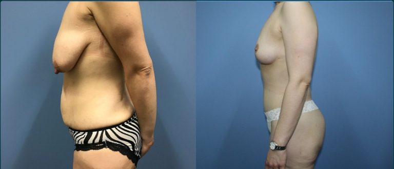 Breast lift with implants (augmentation mastopexy) before and after, 90° left view, female patient, case BLA-L09, Dr Rohit Kumar, Sydney