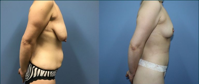 Breast lift with implants (augmentation mastopexy) before and after, 90° right view, female patient, case BLA-L09, Dr Rohit Kumar, Sydney