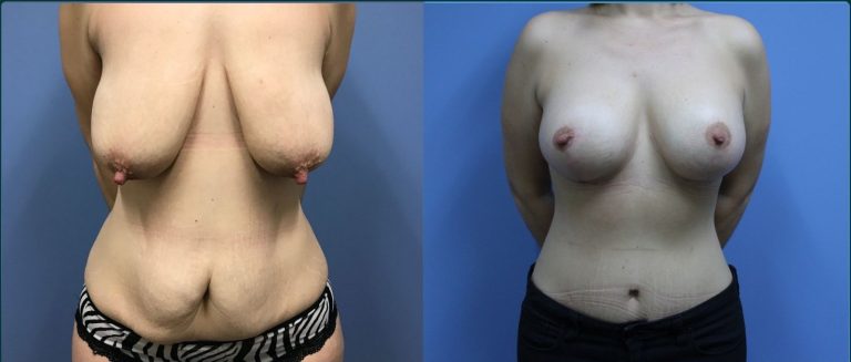 Breast lift with implants (augmentation mastopexy) before and after, front view, female patient, case BLA-L09, Dr Rohit Kumar, Sydney