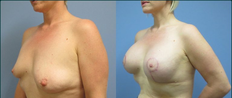 Breast lift with implants (augmentation mastopexy) before and after, 45° left view, female patient, case BLA-L10, Dr Rohit Kumar, Sydney