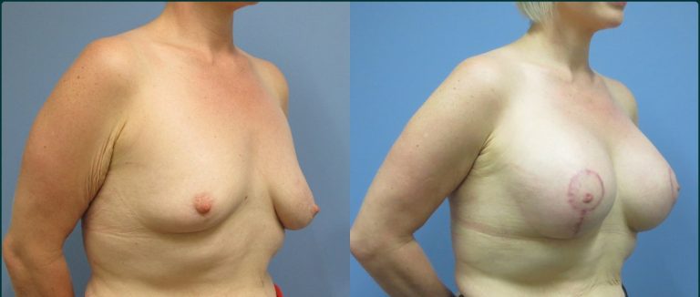 Breast lift with implants (augmentation mastopexy) before and after, 45° right view, female patient, case BLA-L10, Dr Rohit Kumar, Sydney
