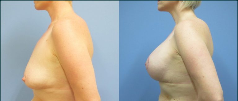 Breast lift with implants (augmentation mastopexy) before and after, 90° left view, female patient, case BLA-L10, Dr Rohit Kumar, Sydney