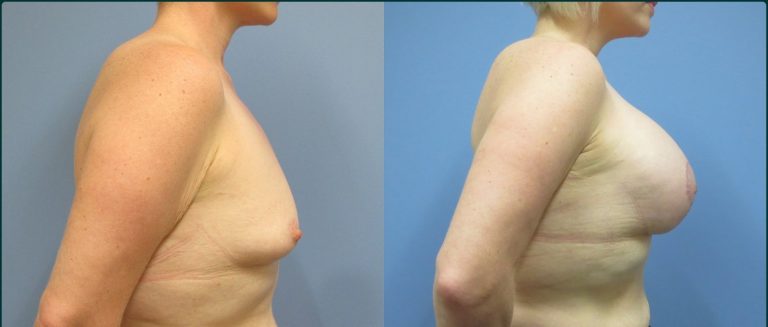Breast lift with implants (augmentation mastopexy) before and after, 90° right view, female patient, case BLA-L10, Dr Rohit Kumar, Sydney