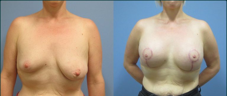 Breast lift with implants (augmentation mastopexy) before and after, front view, female patient, case BLA-L10, Dr Rohit Kumar, Sydney