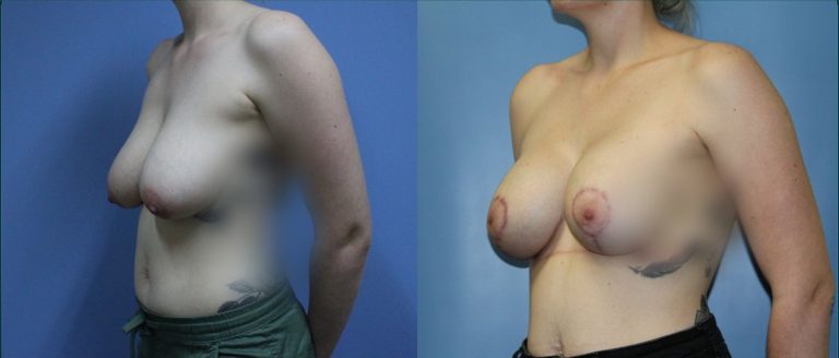 Breast lift with implants (augmentation mastopexy) before and after, 45° left view, female patient, case BLA-L11, Dr Rohit Kumar, Sydney