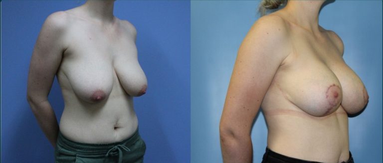 Breast lift with implants (augmentation mastopexy) before and after, 45° right view, female patient, case BLA-L11, Dr Rohit Kumar, Sydney