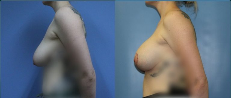 Breast lift with implants (augmentation mastopexy) before and after, 90° left view, female patient, case BLA-L11, Dr Rohit Kumar, Sydney
