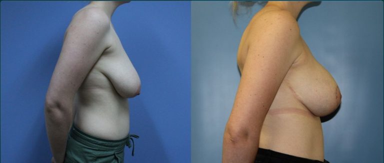 Breast lift with implants (augmentation mastopexy) before and after, 90° right view, female patient, case BLA-L11, Dr Rohit Kumar, Sydney