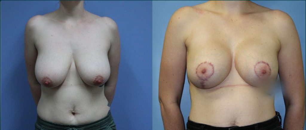 Breast lift with implants (augmentation mastopexy) before and after, front view, female patient, case BLA-L11, Dr Rohit Kumar, Sydney