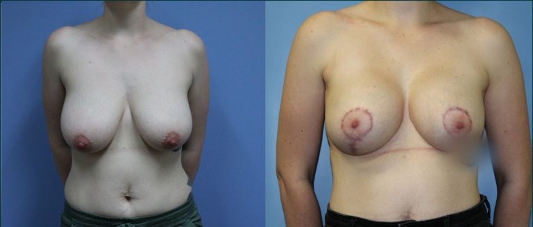 Breast lift with implants (augmentation mastopexy) before and after, front view, female patient, case BLA-L11, Dr Rohit Kumar, Sydney