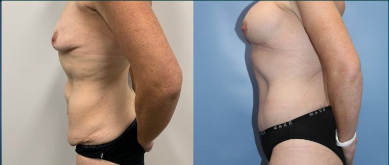 Breast lift with implants (augmentation mastopexy) before and after, 90° left view, female patient, case BLA-L12, Dr Rohit Kumar, Sydney