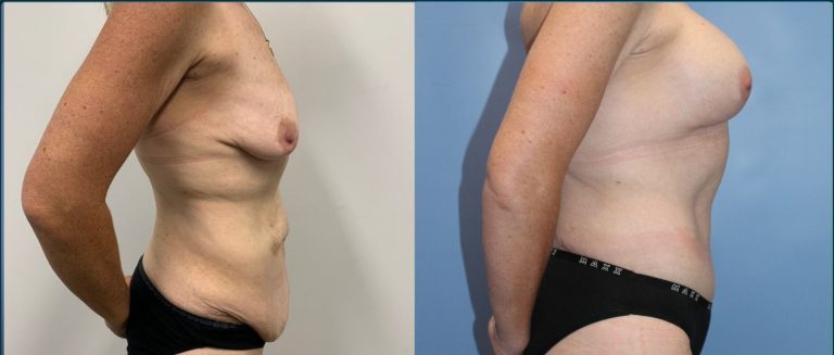 Breast lift with implants (augmentation mastopexy) before and after, 90° right view, female patient, case BLA-L12, Dr Rohit Kumar, Sydney