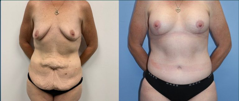 Breast lift with implants (augmentation mastopexy) before and after, front view, female patient, case BLA-L12, Dr Rohit Kumar, Sydney