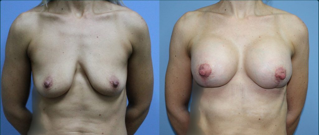 Breast lift with implants (augmentation mastopexy) before and after, female patient, case BLA-L13, Dr Rohit Kumar, Sydney