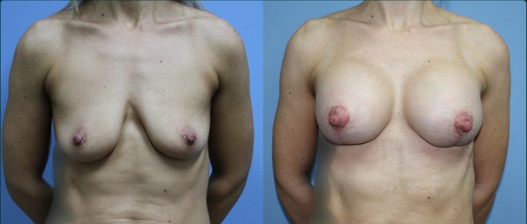 Breast lift with implants (augmentation mastopexy) before and after, female patient, case BLA-L13, Dr Rohit Kumar, Sydney