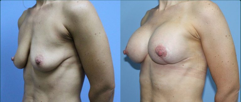Breast lift with implants (augmentation mastopexy) before and after, female patient, case BLA-L13, Dr Rohit Kumar, Sydney