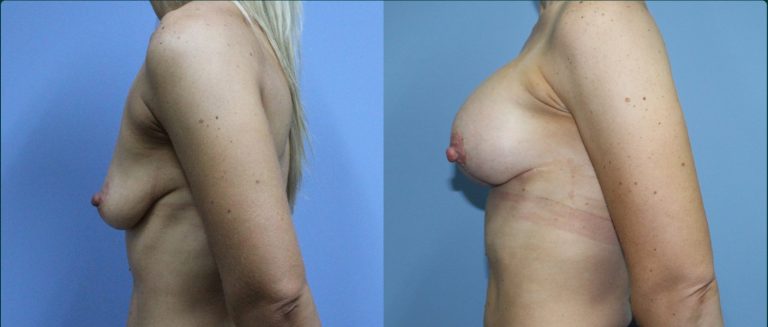 Breast lift with implants (augmentation mastopexy) before and after, female patient, case BLA-L13, Dr Rohit Kumar, Sydney