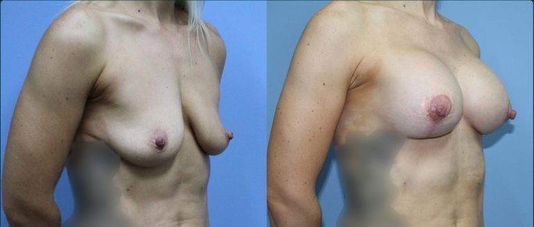 Breast lift with implants (augmentation mastopexy) before and after, female patient, case BLA-L13, Dr Rohit Kumar, Sydney