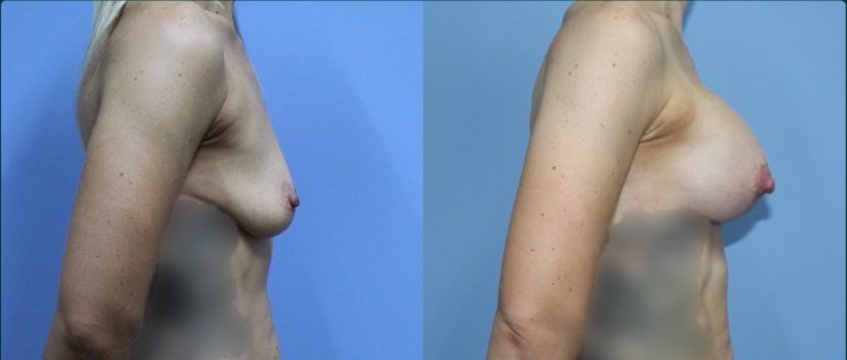 Breast lift with implants (augmentation mastopexy) before and after, female patient, case BLA-L13, Dr Rohit Kumar, Sydney