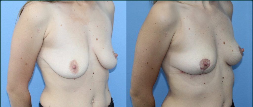 Breast lift (mastopexy) before and after, female patient, case BLI-L01, Dr Rohit Kumar, Sydney