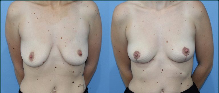Breast lift (mastopexy) before and after, female patient, case BLI-L01, Dr Rohit Kumar, Sydney