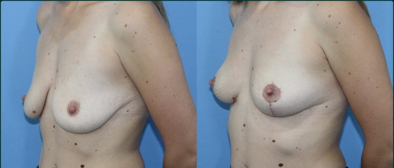 Breast lift (mastopexy) before and after, female patient, case BLI-L01, Dr Rohit Kumar, Sydney